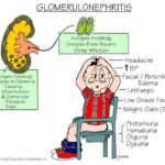 Homoeopathy and its Efficacy in Case of Acute Glomerulonephritis [ Acute kidney infection ]