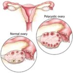 Homoeopathy for PCOD [POLYCYSTIC OVARIAN DISEASE]❗❗