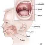 Efficacy of Homeopathy in the Treatment of Adenoids in an 8-Year-Old Child.
