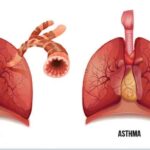 WHY HOMOEOPATHY IN ASTHMA ?