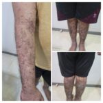 Psoriasis Managed with Homoeopathy