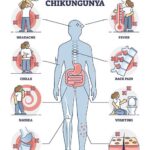 Why Homeopathy in Post Chickengunya Arthralgias [PCA]!!!