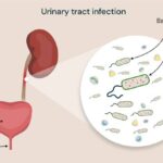 ACUTE CASE OF RECURRENT UTI [ URINARY TRACT INFECTION]
