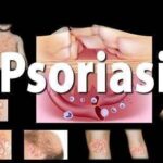 A case of Psoriasis Well Treated with Homeopathy !!!