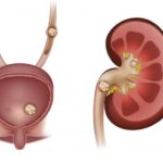 Case of Renal Calculi [Kidney Stone] Managed With Homeopathy ( On going case)!!!