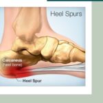 Case of Plantar Fascitis with Calcaneal( Heel ) Spur Managed with Homeopathy !!!